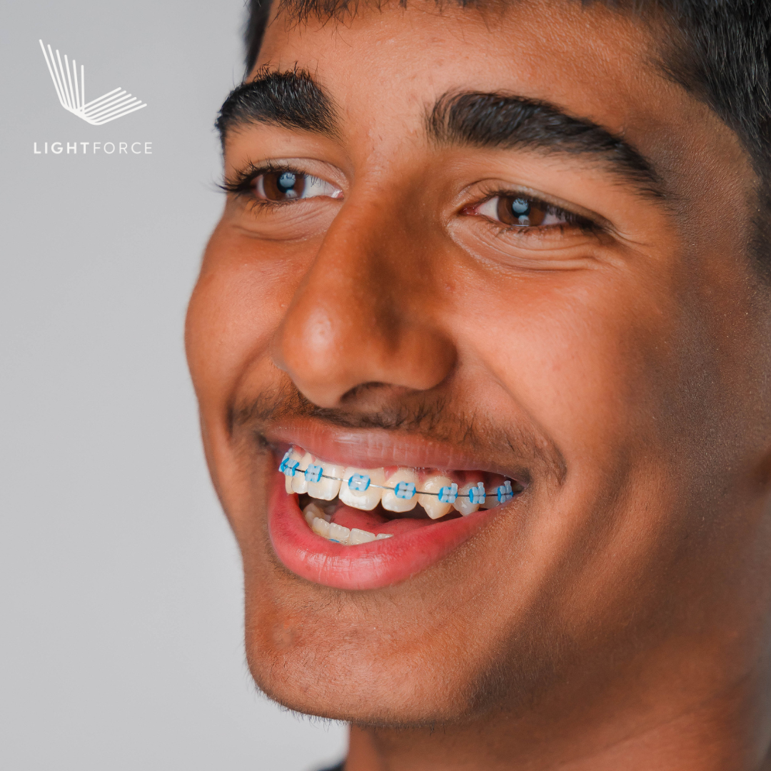 Teen smiling with LightForce 3D-printed ceramic braces with dark blue ties